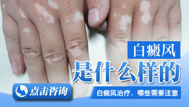 白癜风症状主要有哪些
