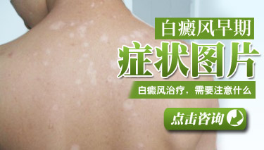 白癜风症状有哪些