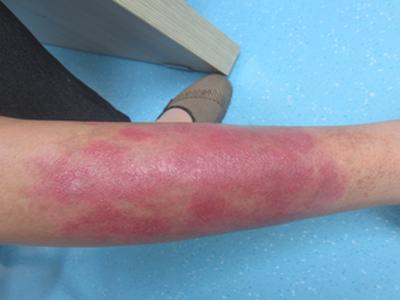 怎样让牛皮癣尽快治好呢