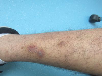 牛皮癣患者需要多吃高蛋白食物吗