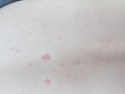 牛皮癣怎么样治疗效果好