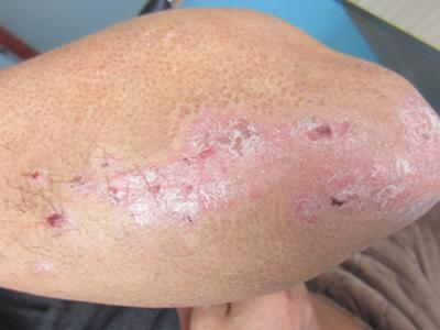 牛皮癣的治疗费用会不会很贵啊