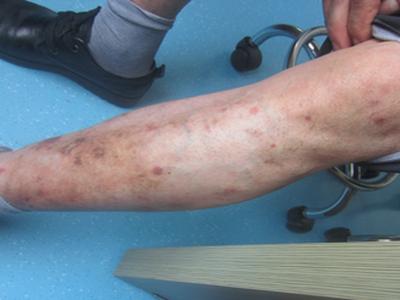 治疗牛皮癣的费用是多少