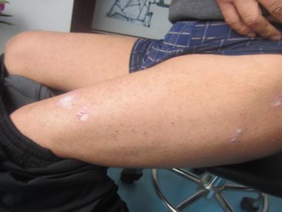 请问治疗牛皮癣的费用