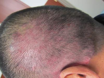 皮肤上起这种牛皮癣,是什么原因