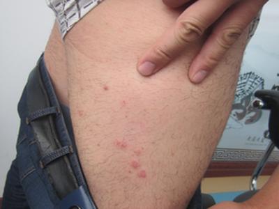 牛皮癣疾病是不治之症吗