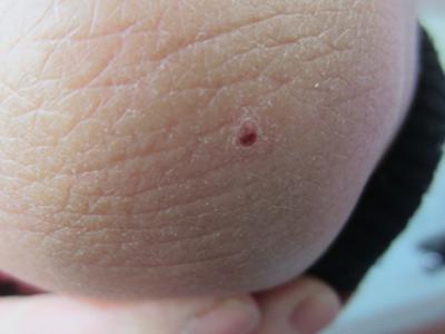 皮肤上出现了牛皮癣请问是什么原因导致的