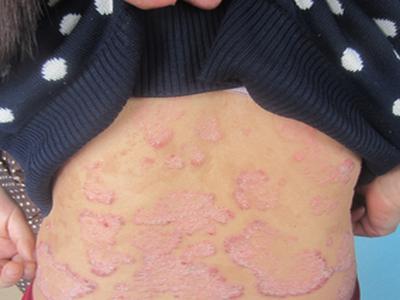 牛皮癣是否可以根治呢