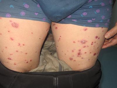 牛皮癣的治疗方法有哪些呢