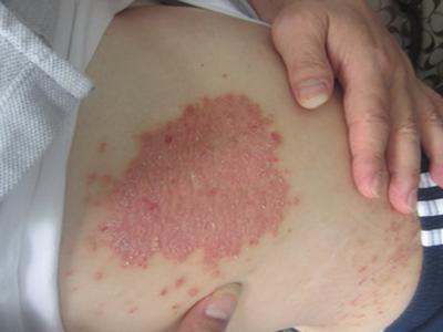 牛皮癣怎样治疗效果好,少复发