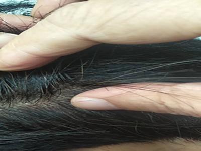 牛皮癣有一年了,反反复复治不好是怎么回事