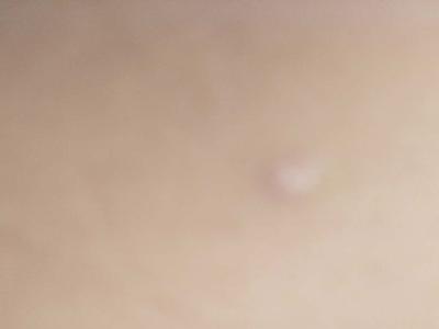 牛皮癣病情总是反反复复怎么办