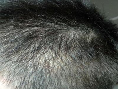 牛皮癣患者怎样防止皮肤感染