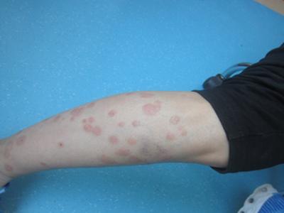 要怎样才能有效的预防牛皮癣复发