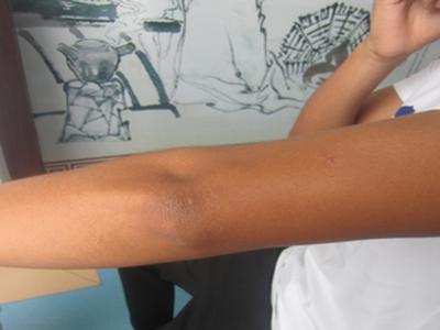 牛皮癣怎么治疗能快好