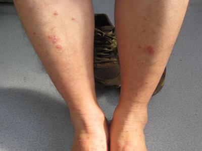 牛皮癣有8个月了怎么治疗