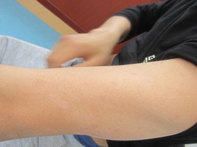 我胳膊上有很多红色的小斑点是不是牛皮癣