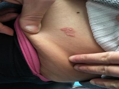 得了牛皮癣怎么办