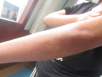 治疗牛皮癣贵不贵?要花多少钱