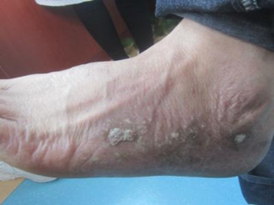 什么方法是可以治好牛皮癣的