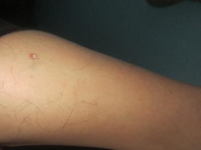 胳膊上为什么出现了牛皮癣