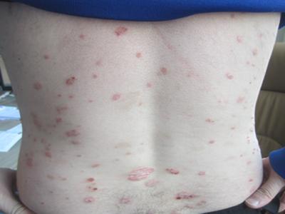 牛皮癣反复发作,怎么办