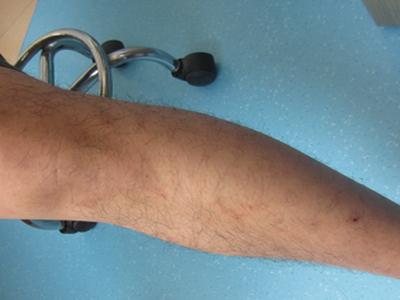 头部已经确诊了是牛皮癣怎么治疗