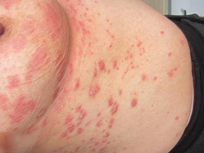 血热型牛皮癣应该吃什么