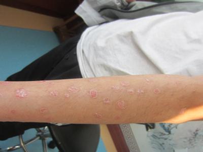 牛皮癣咨询,发病10年了怎么治疗