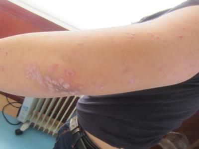 身患牛皮癣怀孕了请问影响胎儿吗