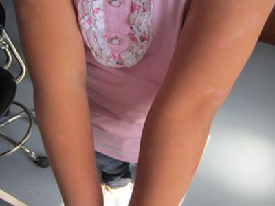 急需牛皮癣需要怎么治疗