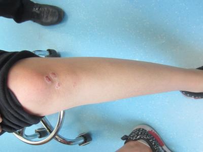 治牛皮癣的阿维a胶囊怎么吃