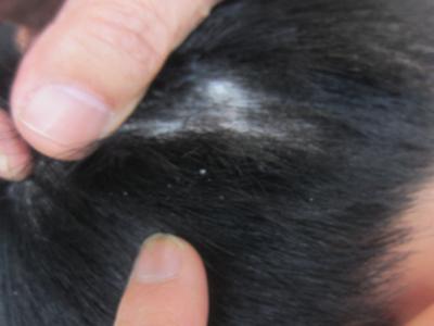 脖子后面长了牛皮癣怎么治