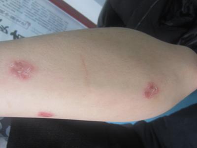 皮肤病牛皮癣到底是什么原因患上的