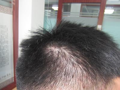 非常严重的脓包型牛皮癣怎么治疗