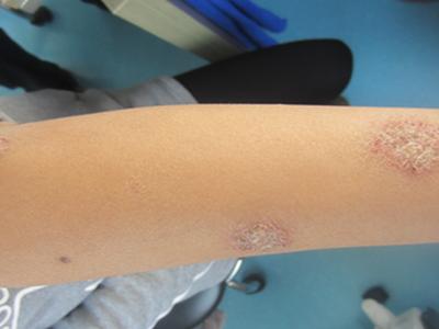 病理报告,这个到底是不是牛皮癣