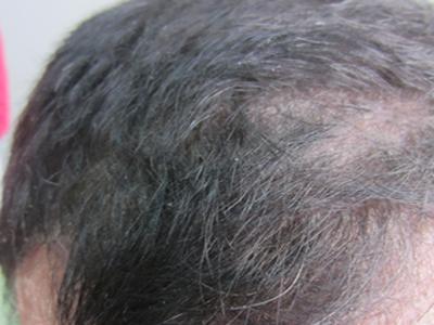 皮肤上有红点子是牛皮癣吗