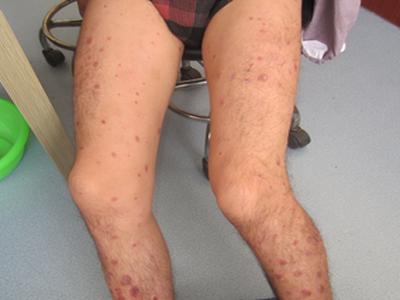 得了牛皮癣怎么办啊