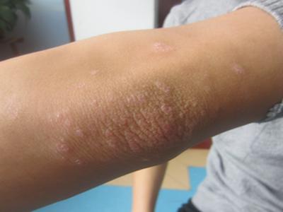 牛皮癣患者可以吃的瓜果有什么