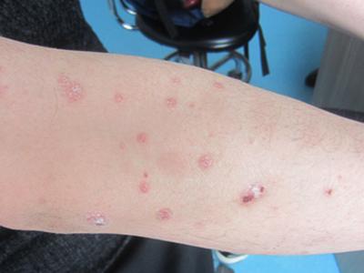 牛皮癣治疗方法选哪种好