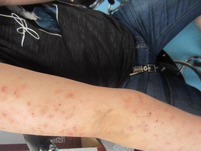 牛皮癣的出现有什么危害