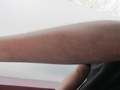 究竟是什么原因导致的牛皮癣久治不愈呢