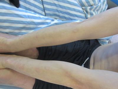 银屑病十几年了,全身都有,银消颗粒有效果吗