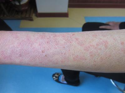 牛皮癣合适吃什么