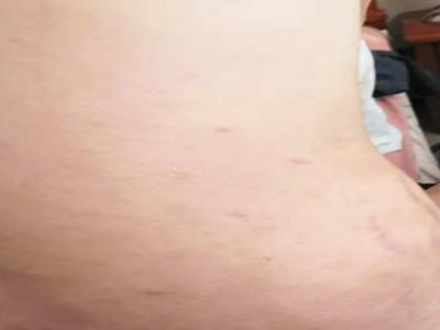身上起小红疹不知道是不是牛皮癣