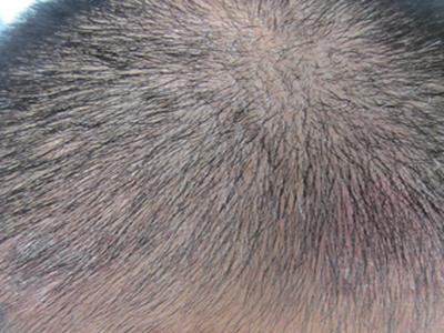 治牛皮癣的老秘方有哪些