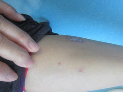 治牛皮癣自愈的方法