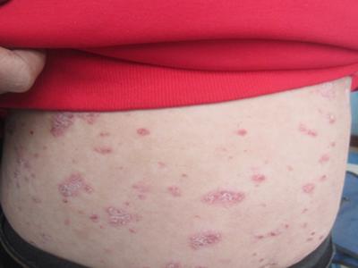 牛皮癣危害眼睛吗