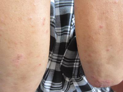 成都银康银屑病医院收费贵吗