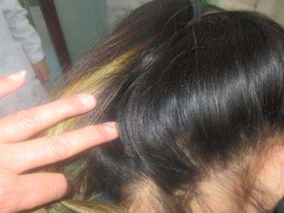 寻常型牛皮癣传染么